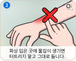 화상 입은 곳에 물집이 생기면 터트리지 말고 그대로 둡니다.