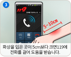 화상을 입은 곳이 5cm보다 크면 119에 전화를 걸어 도움을 받습니다.