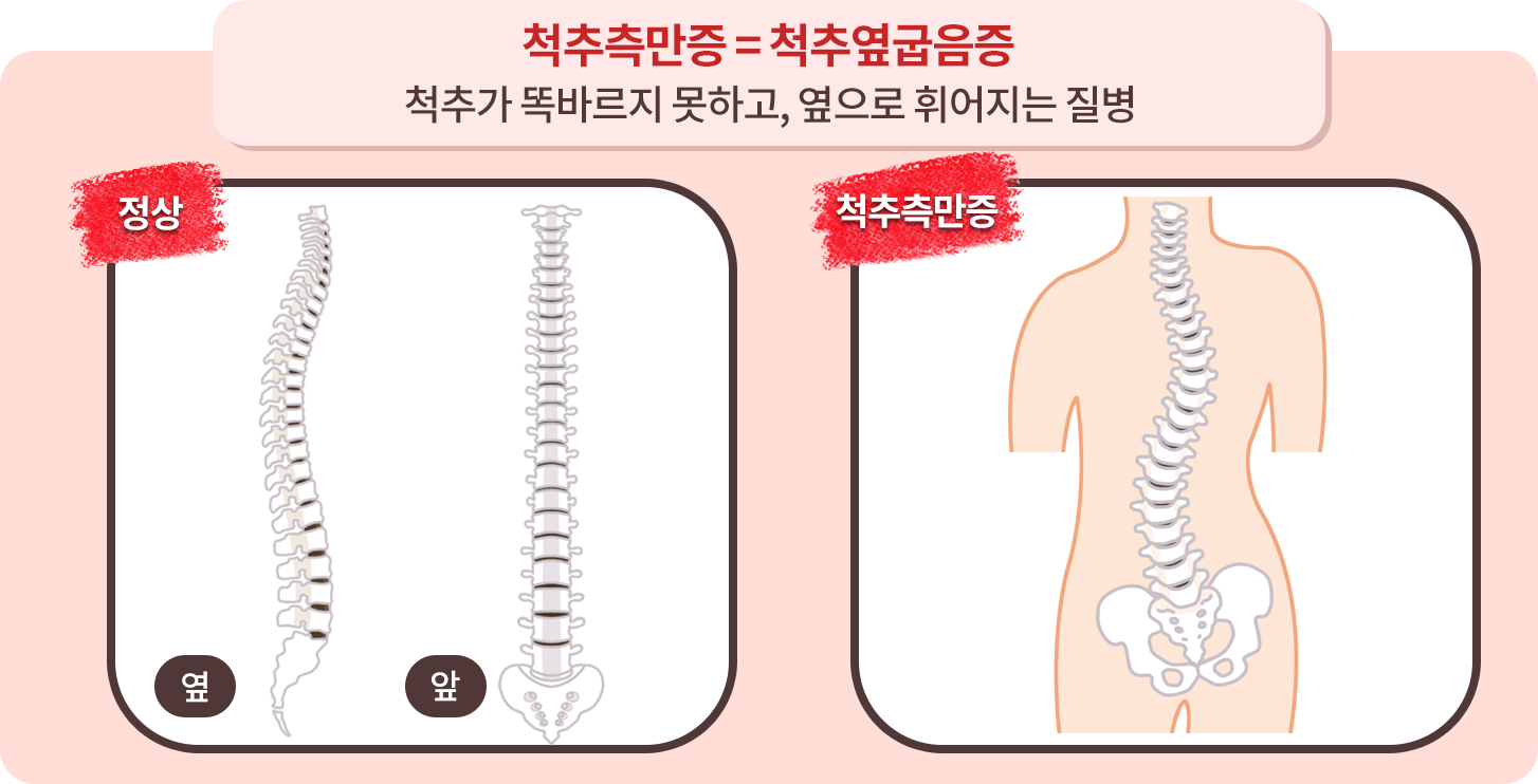 척추측만증
